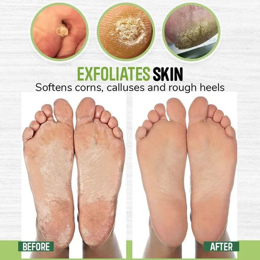 Anti-Fungal Detox Foot Soak